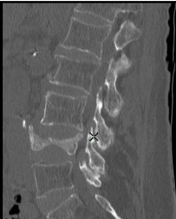 Burst Fracture x-ray.jpg