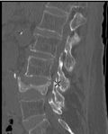 Burst Fracture x-ray.jpg